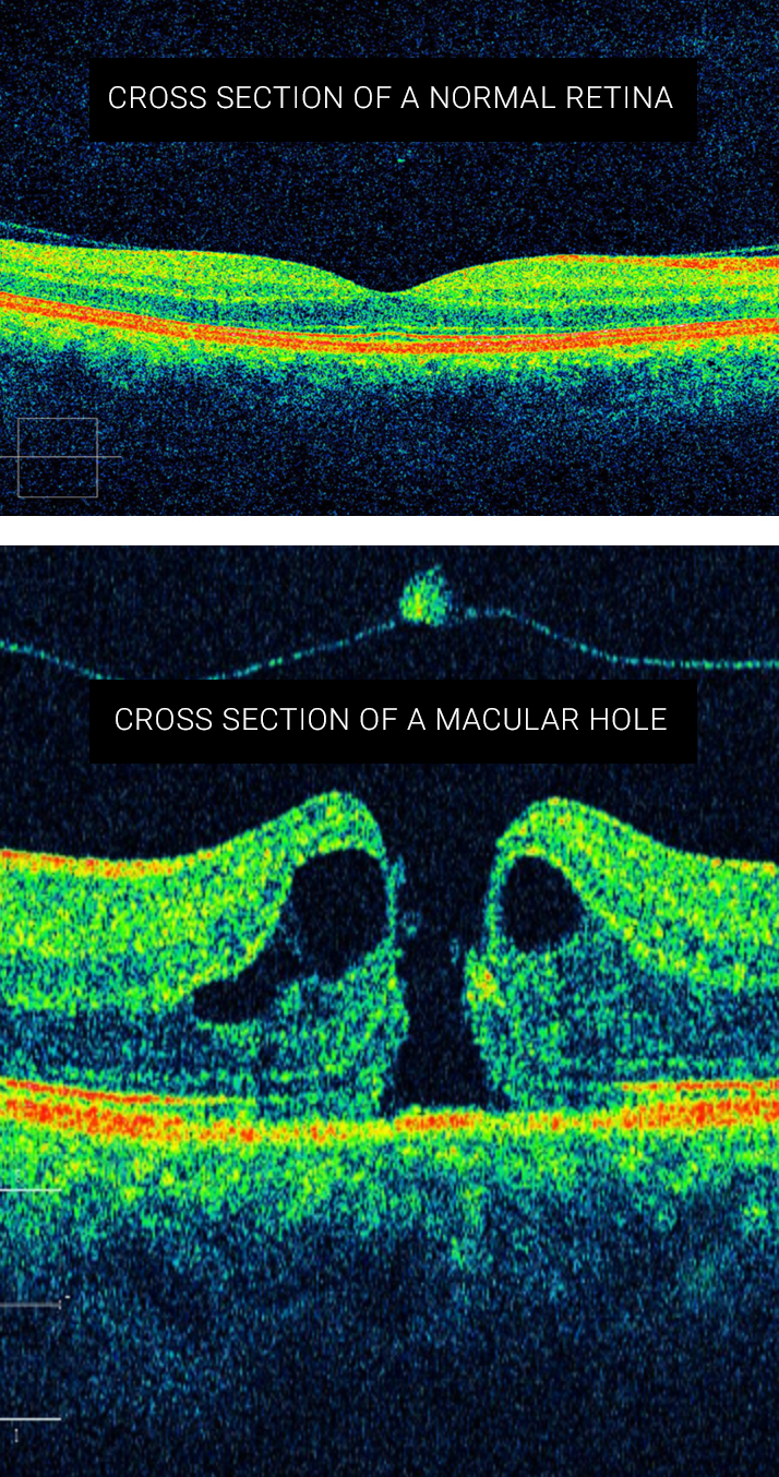 Taylors Optometrists: OCT 3D Retinal Scans